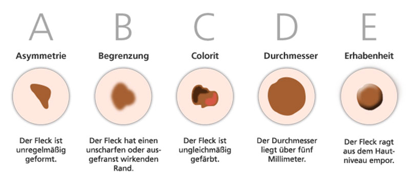 Schaubild ABCDE-Regel: Hautkrebs-Früherkennung